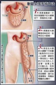 象腿病