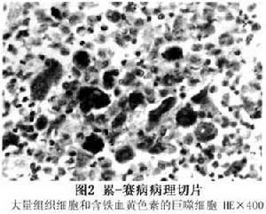 萊特雷爾-西韋病