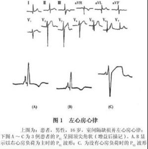 左心房心律