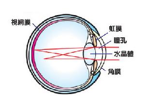 （圖）散光 病因