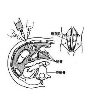 腹腔穿刺