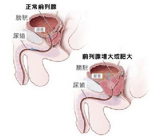 良性前列腺增生