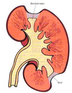 慢性腎盂腎炎