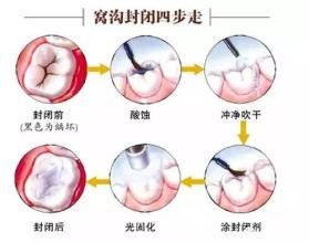 兒童窩溝封閉