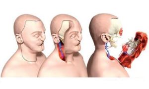 面部異體組織移植術的示意圖