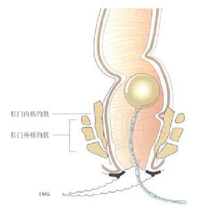 肛門梳硬結