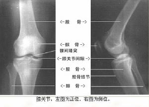 膝關節急性滑膜炎