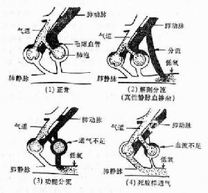 老年呼吸衰竭