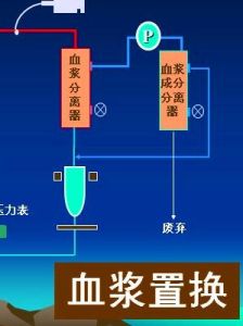 血漿置換