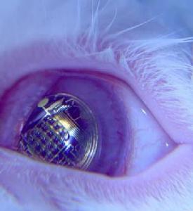 視網膜晶片