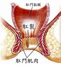 肛門裂