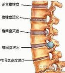 腰椎間盤突出症康復