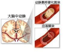 腔隙性腦梗死