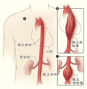 升主動脈瘤