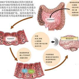 IBS[腸易激綜合徵]