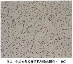 非結核分枝桿菌性角膜炎