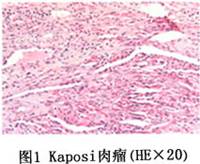 卡波氏肉瘤