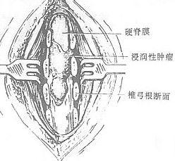 椎管內腫瘤切除術