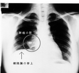 老年人肺癌