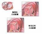 瓣膜替換