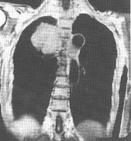 原發性乳腺惡性淋巴瘤