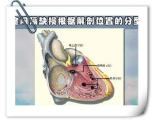 主動脈騎跨 