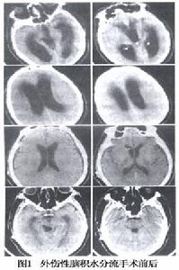 外傷性腦積水