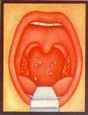 咽白喉