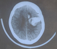 高顱壓性腦積水