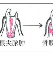 牙槽膿腫