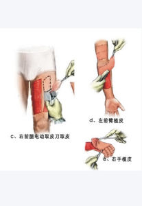 植皮手術