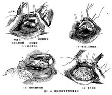 心房間隔缺損