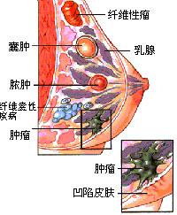 侵潤性乳腺癌