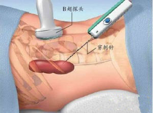 腎穿刺活檢術