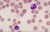 小細胞低色素貧血