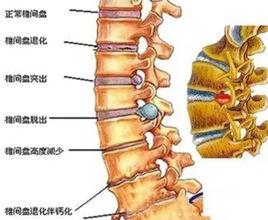 腰椎退變