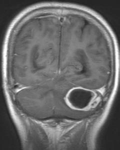 顱內併發症-耳源性腦膿腫