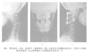 （圖）上頸椎不穩症