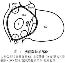 小兒房間隔缺損