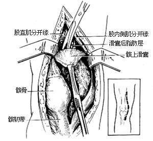 （圖）膝關節結核