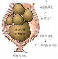 肛門直腸先天畸形