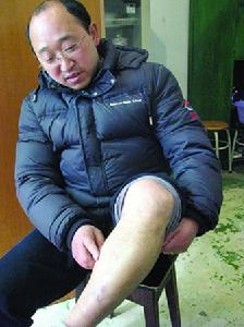 （圖）地震給劉寧腿上留下的傷痕至今尚未完全消退