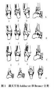 （圖）踝關節骨折