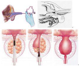 前列腺電切術
