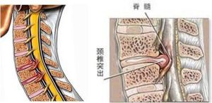 頸椎退行性變