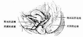 生殖器官瘺-尿瘺
