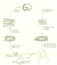 繞蟲病病理圖片