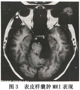（圖）腦內表皮囊腫