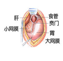 賁門失馳症