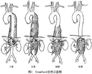 胸腹主動脈動脈瘤